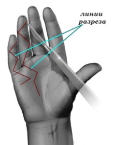 contractura3