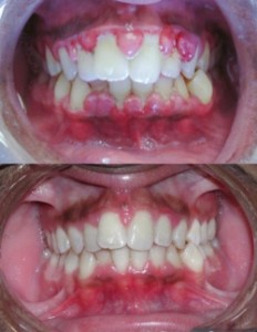 gingivitis_before_and_after-2