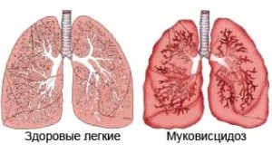 муковисцидоз-симптомы-2-300x169
